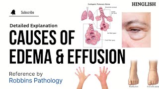 Edema Oedema  Part 2  Causes Of Edema  Hemodynamic Disorders Pathology  KTC MBBS [upl. by Brouwer935]