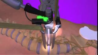 The XLIF® eXtreme Lateral Interbody Fusion procedure [upl. by Gnoud699]