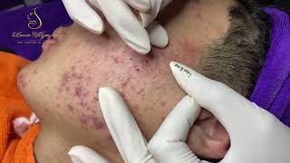 Loan Nguyen Acne Treatment 15722 [upl. by Nelubez]