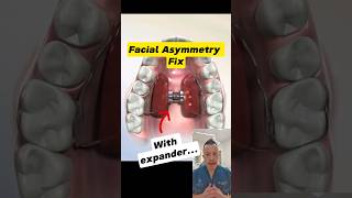 Fixing Facial Asymmetry with a Palate Expander Heres How dentallan dentist shorts [upl. by Neffirg]