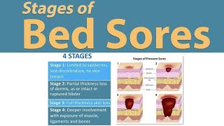 what is the Bed sore pressure sores ulcer Dr Health Officials [upl. by Heater15]