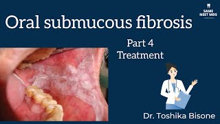 Treatment and Management of OSMF  Oral submucous fibrosis  Part 4 [upl. by Pape577]