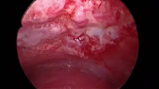 Rigid Thoracoscopy  Pleural Biopsy  Talc Poudrage  Malignant Pleural effusion [upl. by Ronen]