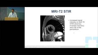 Pericardial Cases Does Pericarditis Ever Get Better [upl. by Enaoj927]