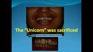 Extra tooth between front teeth  Fixed braces amp no teeth removed [upl. by Nosiddam]