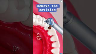 Animation of removal dental Caries [upl. by Aiasi]