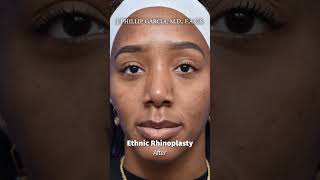 Ethnic Rhinoplasty [upl. by Carnahan]