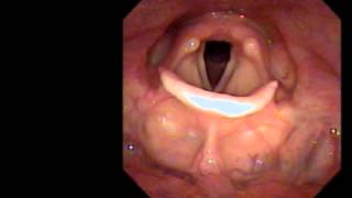 Normal laryngoscopy [upl. by Anirb]