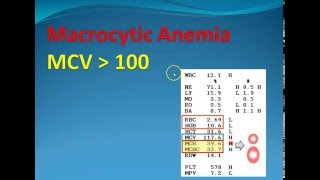 Hematology 2 Macrocytic Anemia [upl. by Alan]