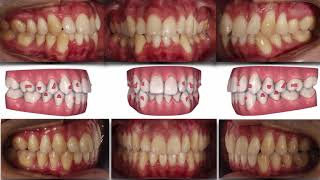 Invisalign courseSevere crowding Treated Non extraction [upl. by Arleen]