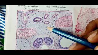 Teratoma Testicular Teratoma Revision MBBS PATHOLOGY [upl. by Anairotciv]