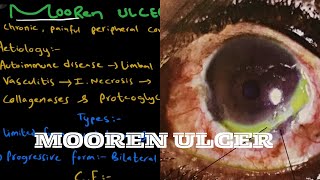 Mooren’s Ulcer  Peripheral Corneal Ulcer [upl. by Amiaj]