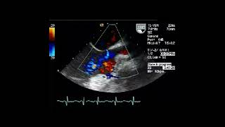 O Eco Transesofágico no estudo das Cardiopatias Congênitas [upl. by Carilla]