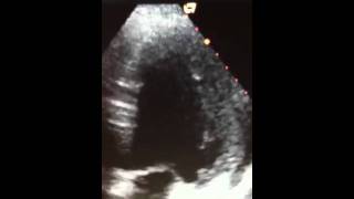 Paradoxical septal motionultrasoundlifecom [upl. by Ludly]