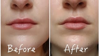 3 Ways To Permanently Enhance Lips Without Lip Injections  Before amp After [upl. by Nesaj]