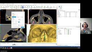 Materialise Mimics Quickstart Segmentation Skull [upl. by Jola687]