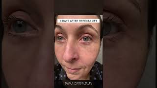 Before amp 4 Days After Trifecta Lift for Eye Bags Crepey Skin and Volume Loss  Beverly Hills CA [upl. by Raskind950]