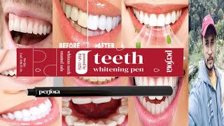 Perfora Teeth Whitening Pen  Honest Review [upl. by Nixie221]