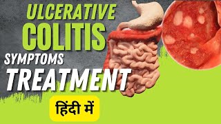 Ulcerative colitis symptoms and treatment  Inflammatory bowel disease [upl. by Mable443]