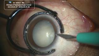 Chirurgie de la cataracte sans sutures par ultrasons  PHACOEMULSIFICATION [upl. by Sassan569]