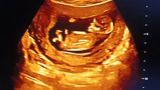 Its a baby boy 12weeks old ultrasound baby healthybaby babyboy subscribe [upl. by Noskcaj755]