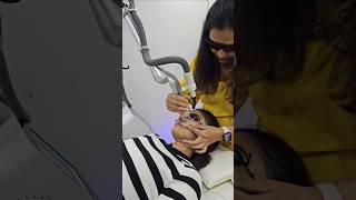 Laser Treatment for Acne Scars  acne shorts [upl. by Zendah]