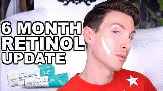 FIRST 6 MONTHS ON RETIN A  BEFORE AND AFTER TRETINOIN CREAM [upl. by Gariepy]