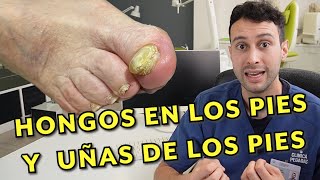 🦶 HONGOS en los PIES y UÑAS de los pies  Onicomicosis síntomas tratamiento prevención y dudas [upl. by Garlanda]