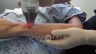 Fraxel Laser  Arm Skin Resurfacing  Collagen Remodeling  Beverly Hills California [upl. by Adnorehs]