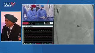 Live Case 1  Impella Supported PCI of Calcified LAD using Rotational Atherectomy and OCT Guidance [upl. by Menon]