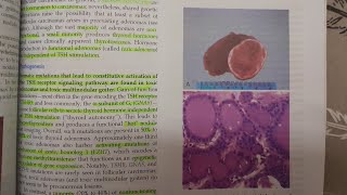 Thyroid Adenoma  SPECIAL PATHOLOGY [upl. by Clyte]