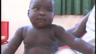 The Ponseti Method The Treatment of Clubfoot Part 1 [upl. by Ahsener300]