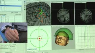 Robotic TMS Motor Mapping Over Predefined Grid [upl. by Eedoj]