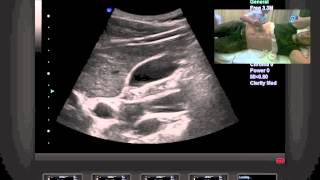 Instructievideo abdominale echografie [upl. by Eelyac]