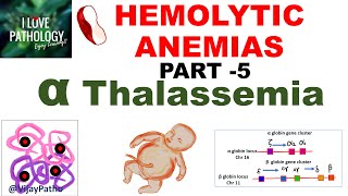 Hemolytic Anemias Part 5 Alpha Thalassemia Pathogenesis types Diagnosis amp Treatment [upl. by Kistner180]