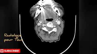 ANGIOSCANNER DES TRONCS SUPRAAORTIQUESCalcifications marquées des deux bifurcations carotidiennes [upl. by Nylazor861]