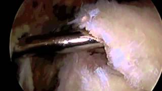 Arthroscopic Rotator Cuff Repair Surgery with SAD Dr Eric Janssen [upl. by Arianna]