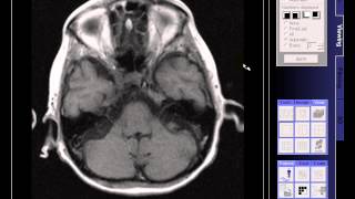 BRAIN MRI OLD INFARCTION [upl. by Htebilil]