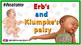 Erbs palsy and klumpkes palsy USMLE Animation  Etiology Clinical features Diagnosis Treatment [upl. by Girish]