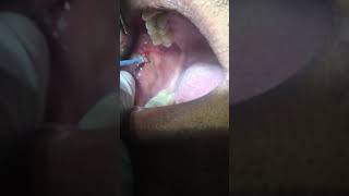 Removal of Leukoplakia Patch using RF Electrosurgery Unit Dr Ankit Goel Hapur [upl. by Suivatnod]