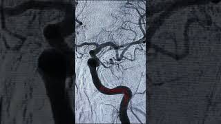 Cerebral Angiogram  Session 3 [upl. by Airogerg]