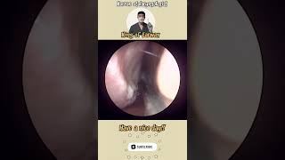 rhinorrhea sinusitis bersihkankuping satisfyingvideos pembersihan telinga video puas hati [upl. by Esirahc]