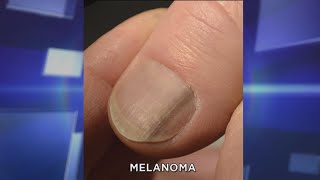 Subungual Melanoma What You Need to Know [upl. by Bellda]