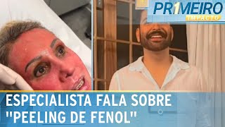 Dermatologista explica como funciona o “peeling de fenol”  Primeiro Impacto 040624 [upl. by Gnoud]