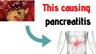 Do You Know This Important Cause of Pancreatitis [upl. by Pouncey665]