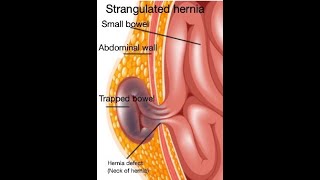 Strangulated hernia symptoms [upl. by Ogaitnas]