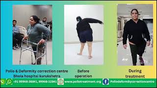 polio benefits of Polio treatment deformity correction [upl. by Annoved221]