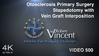 Otosclerosis Primary Surgery Stapedotomy with Vein Graft Interposition [upl. by Lauren244]