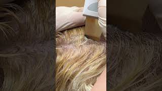 Scalp Treatment for Dandruff Removal [upl. by Agnizn]