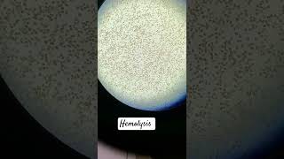 Hemolysis in RBC [upl. by Dole225]